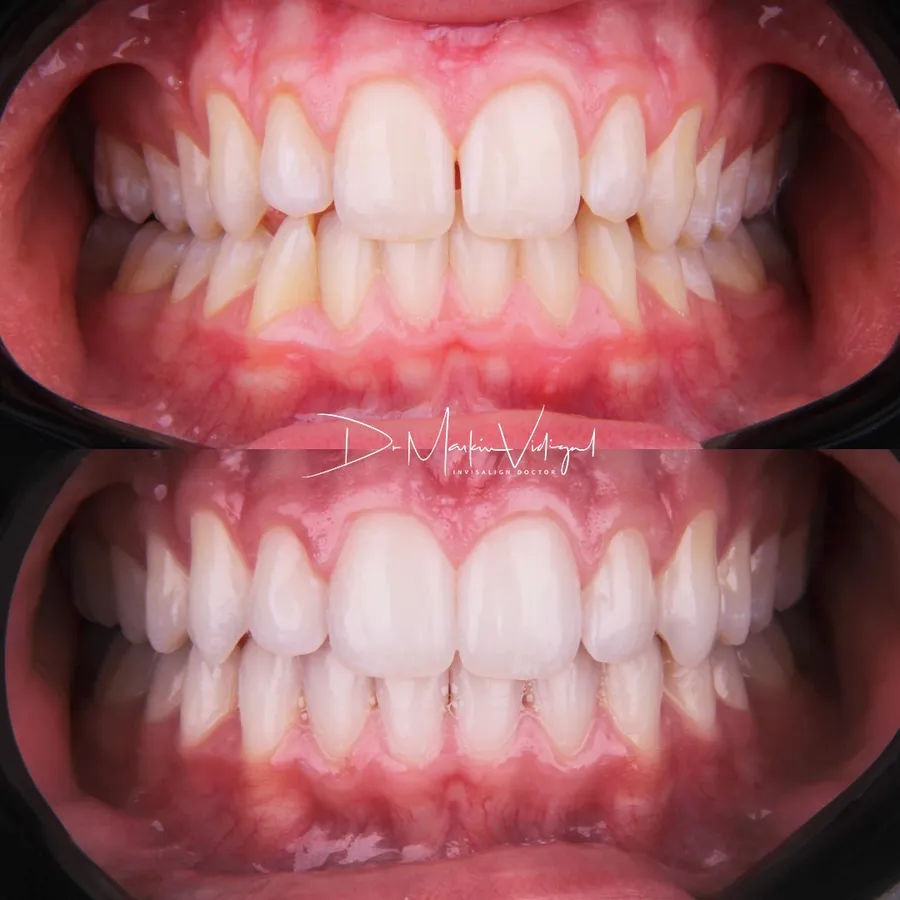Antes e depois de Invisalign: dentes apinhados e girados, depois alinhados