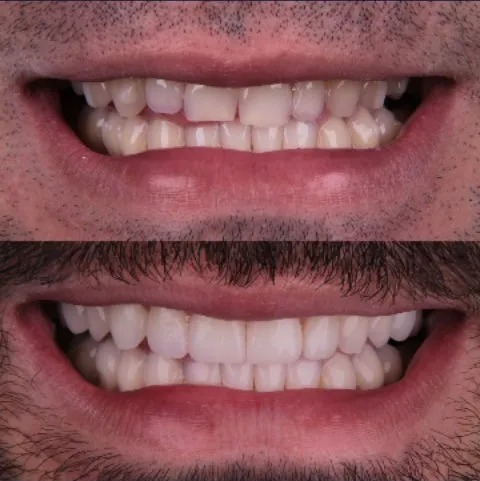 Antes e depois: sorriso tratado com Invisalign e finalizado com lentes de contato dental