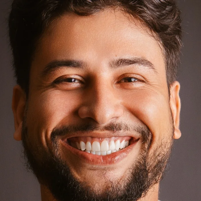 Depois: Mateus sorrindo com as facetas em resina