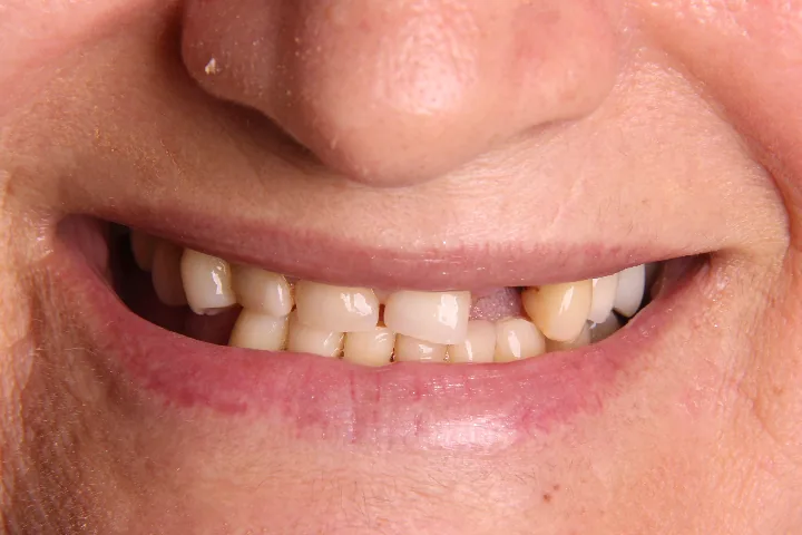 Antes: sorriso de perto, com dentes gastos, escurecidos e espaços entre eles